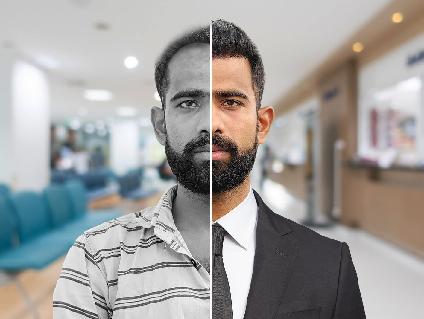 Hairline transplant before after results